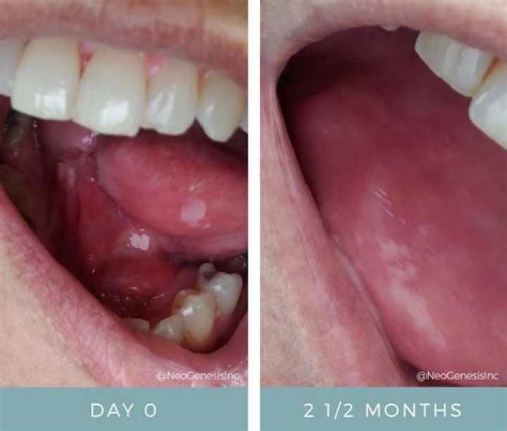 Unveiling the Power of "Under the Tongue" Treatment